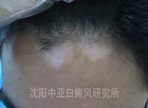 (3月8日,初诊时,患者额头处白斑明显,边缘模糊,处于进展期)